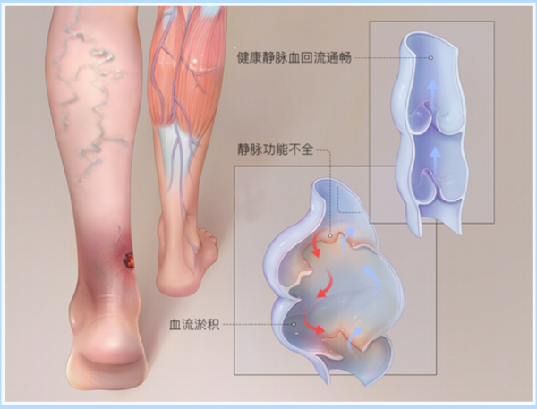 微波消融 | 微创治疗静脉曲张 与下肢静脉曲张说“分手”